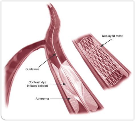 Angioplasty Of The Leg Arteries Causes Symptoms