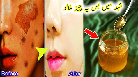 how to remove dark spots with honey get rid of acne scars permanently 100 effective remedy