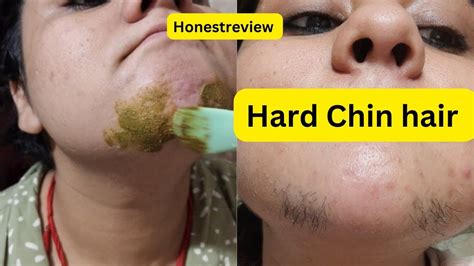 I Tried Hade Facial Hair Removal आदमी जैसे मोटे बाल Faceमोटे Chin हेयरhard Chin Hair