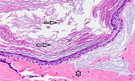 Cureus Large Unruptured Perineal Epidermoid Cyst A Rare Case