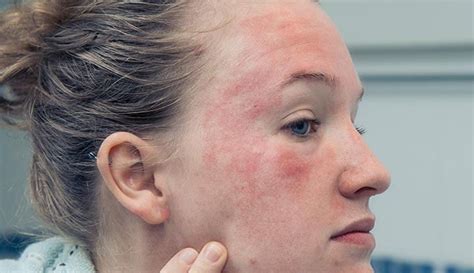 Eczema On Face Symptoms Causes Types And Treatment