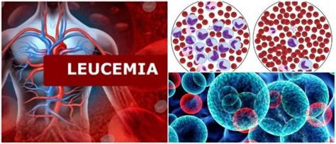 Leucemia Definición Tipos Factores De Riesgo Síntomas Diagnóstico