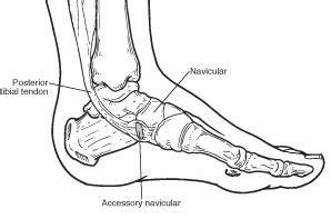 Accessory Navicular Sussex Foot And Ankle Clinic