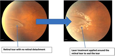 Shah, md, with the retina institute in st. Floaters / Retinal conditions - Hesed Eye Specialists