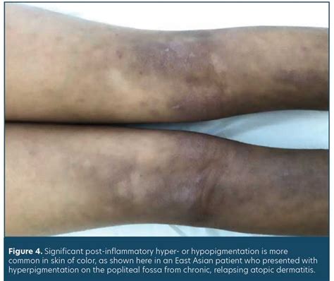 Dermatological Conditions In Skin Of Color— Managing Atopic Dermatitis