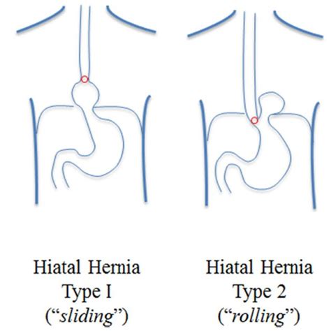 Classification Of Hiatal Hernias Paraesophageal Hernias Are Of Type