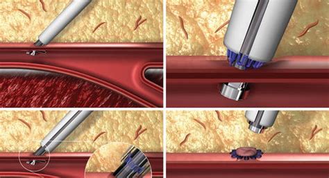 Cerebral Angiography And Groin Access And Closure Radiology Key