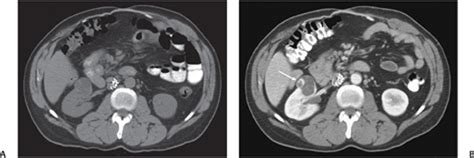 64 Cystic Renal Cell Carcinoma Radiology Key