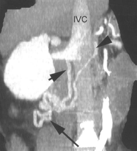 Detecting Bleeding Duodenal Varices With Multislice Helical Ct Ajr