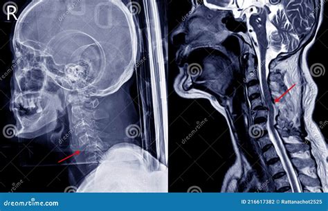 X Ray Image And Mri Of Cervical Spine Case Trauma Showing C