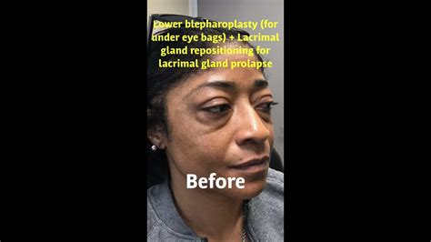 African American Lower Blepharoplasty Dr Mehryar Taban Call 310
