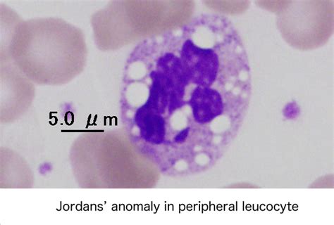 Jordans Anomaly In White Blood Cells Medical Laboratories