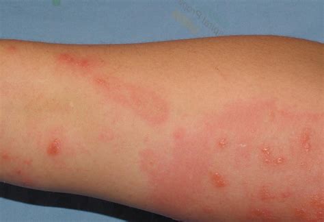 Allergic Reaction Rash On Arms