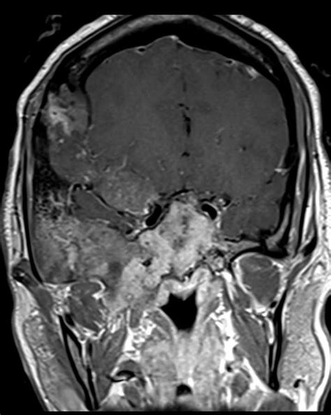 Fibrous Dysplasia Mri Neuro Mr Case Studies Ctisus Ct Scanning