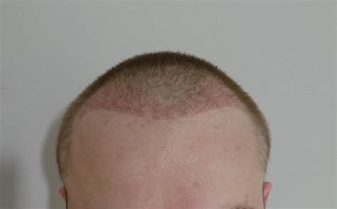 Fue Post Op Pictures Weeks To Hair Transplant Story