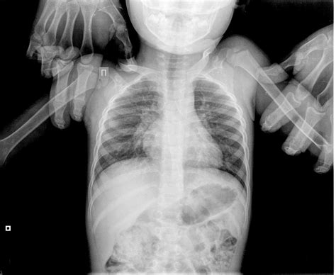 Как выглядит пневмония на рентгене
