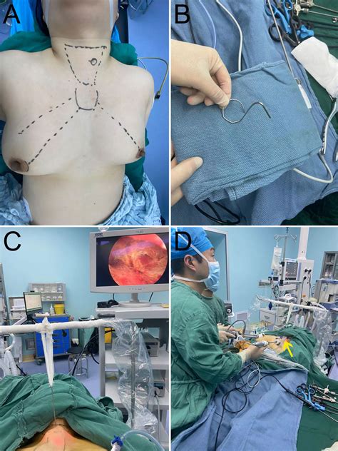 Frontiers Gasless Endoscopic Thyroidectomy Via Modified Areola