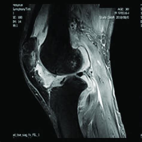 Knee Magnetic Resonance Imaging Mri Showing A Joint Effusion