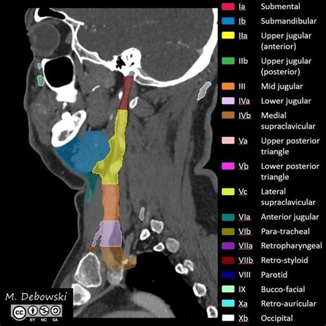 Lymph Node Levels Of The Head And Neck Annotated Ct Radiology Case