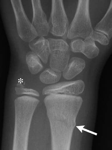 Frontal Radiograph Of The Left Wrist In A 10 Year Old Boy