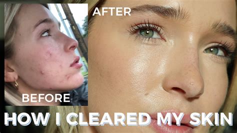 How I Got Rid Of My Acne And Cleared My Skin Adult Cystic And Hormonal