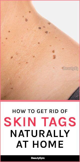 how to remove skin tags naturally at home artofit