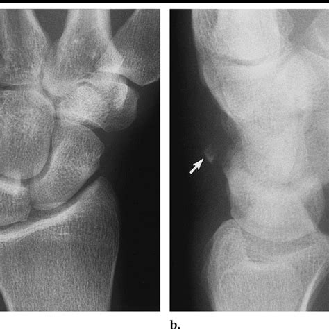 Triquetral Fracture A Pa Radiograph Of The Right Wrist Demonstrates