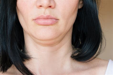 Double And Sagging Chin Treatment At Define Medical Clinic Beaconsfield