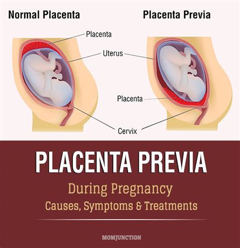 Pain With Placenta Previa Placenta Accreta And Total Placenta Previa