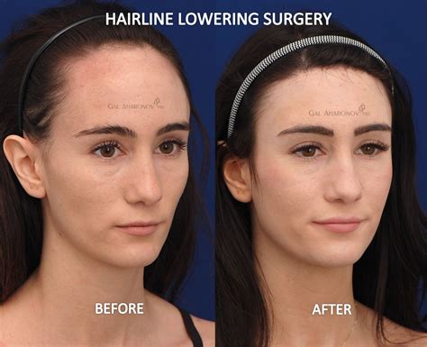How Much Does Forehead Reduction Surgery Cost How Much Rto