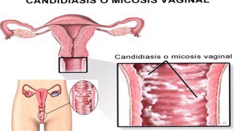 Candidiasis Vaginal Saludiaria