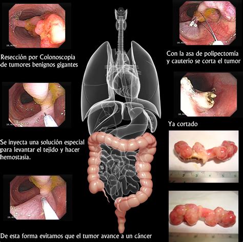 Colonoscopia Gastroenterologo El Salvador Gastroenterologo El Salvador