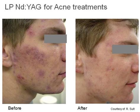 Fotona 4d Acne Treatment