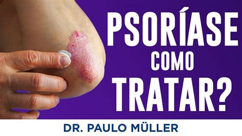 Psoríase Causas E Tratamentos Dr Paulo Müller Dermatologista Youtube