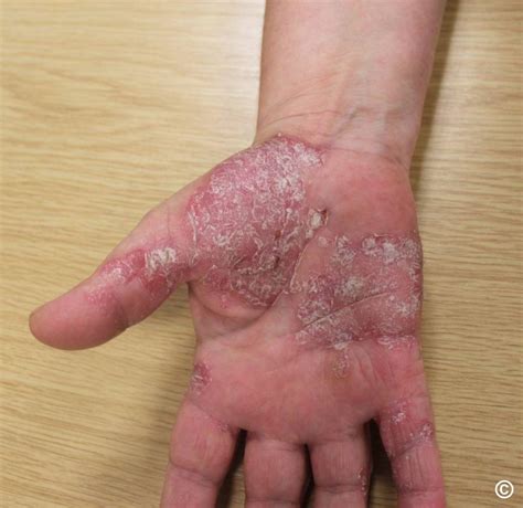 Psoriasis