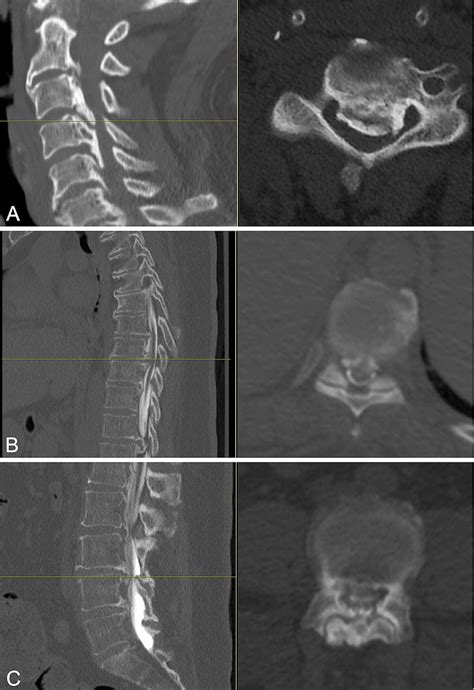 Sample Axial Ct Myelogram Images Demonstrating Degree Of Stenosis In