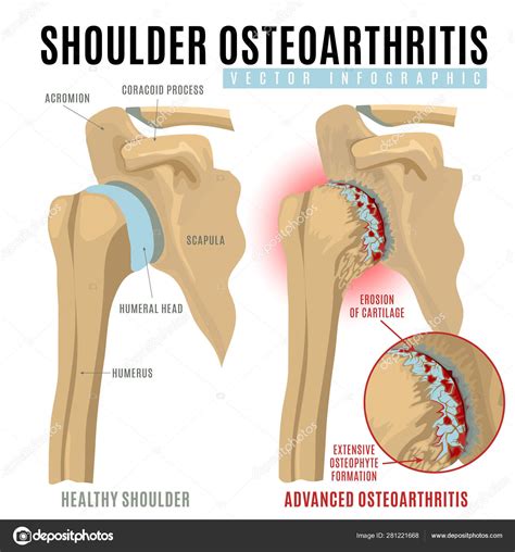 Shoulder Osteoarthritis Infographic Cartoon Vector Cartoondealer The The Best Porn Website
