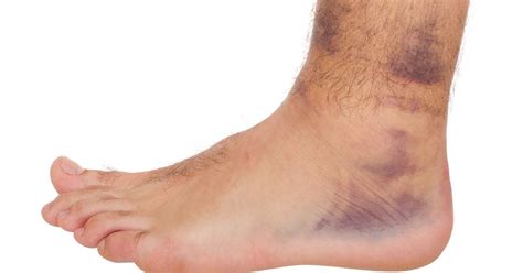 Ankle Sprain Mechanism Of Injury Diagnosis And Treatment Options Dr