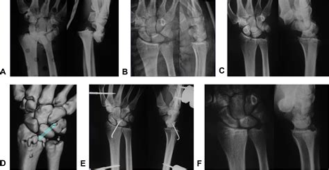Carpal Instability Nondissociative Following Acute Wrist Fractures