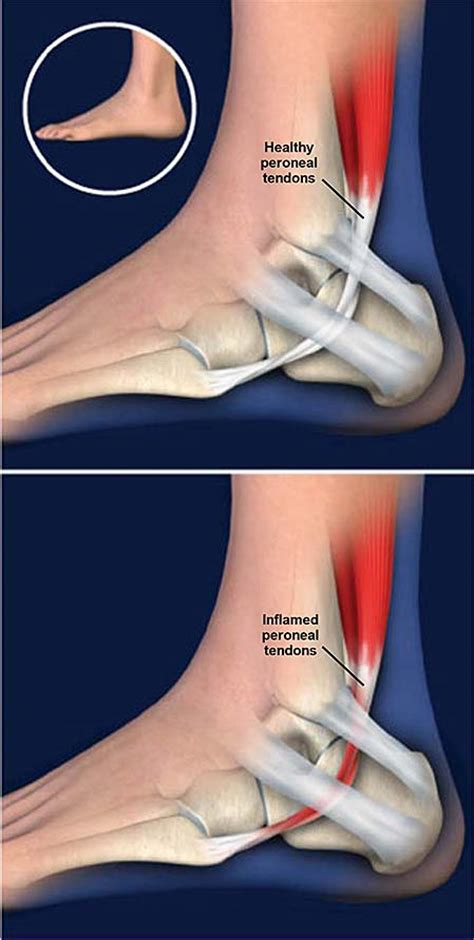 Peroneal Tendonitis Central Coast Orthopedic Medical Group