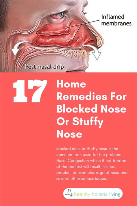 Blocked Nose Or Stuffy Nose Is The Common Term Used For The Problem