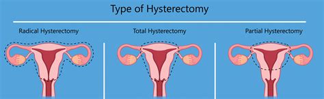 7 Aspects Of Hysterectomy You Need To Know