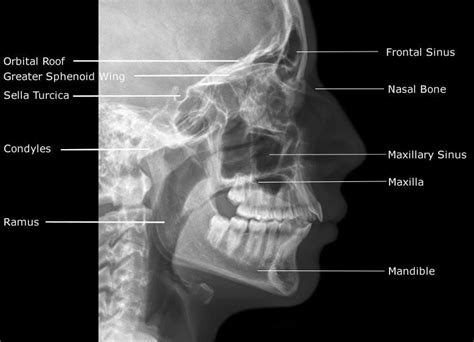 Radiographic Anatomy Of Facial Bones Postero Anterior Caldwell View