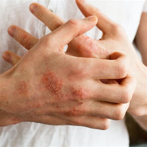 Kidney Disease And Skin Rash