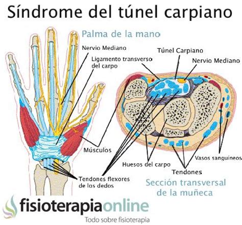 Síndrome Del Túnel Carpiano Causas Y Tratamiento Fisioonline