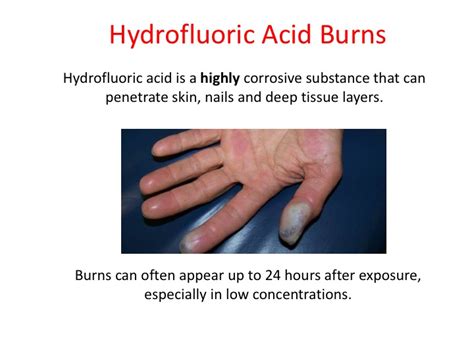 Hydrofluoric Acid Burn