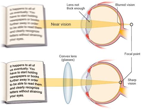 How Can Presbyopia Be Corrected