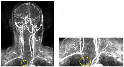 Magnetic Resonance Angiogram Mra In Right Subclavian Carotid Double