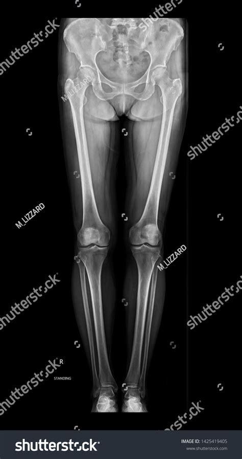 X Ray Whole Leg Lower Extremity Scanogram Stock Illustration 1425419405