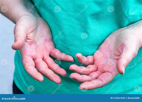 Atopic Dermatitis The Woman Looks At Red And Chapped Hands With Severe